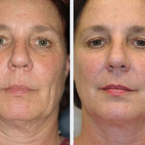 Botox (Anti-Aging)