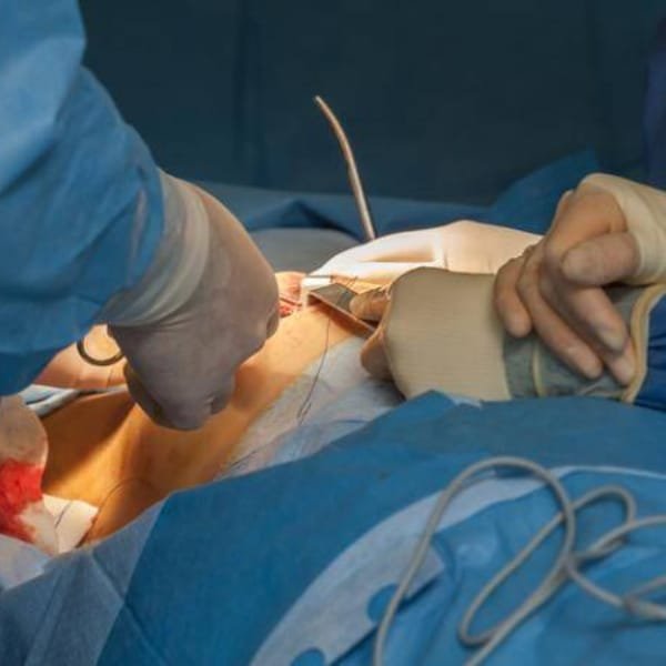 Gynecomastia Surgery (Male Breast Reduction)
