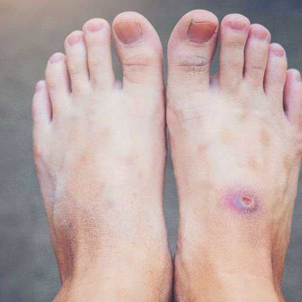 Diabetic Foot Management