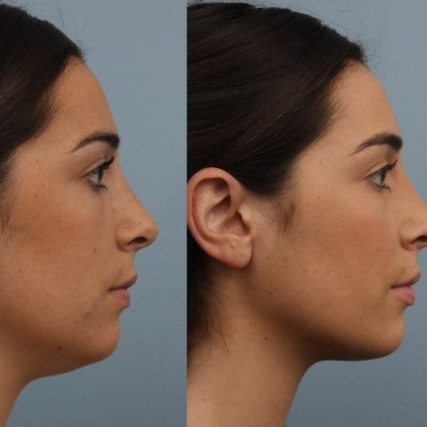 Double Chin Reduction