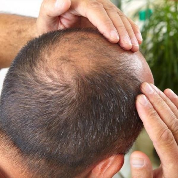Hair Regrowth Treatments
