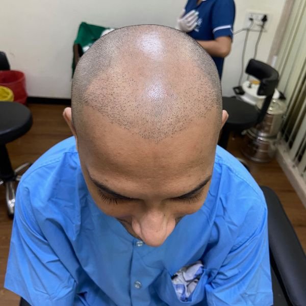 Hair Transplant Doctor Bhopal