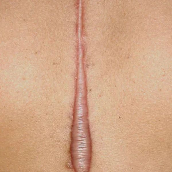 Keloid Treatment