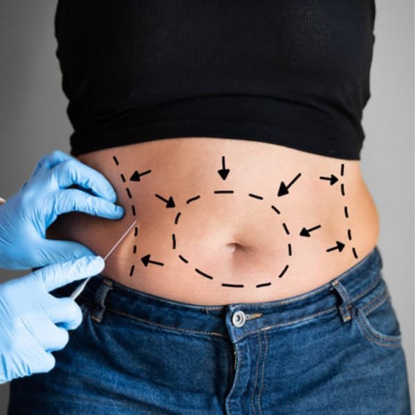 High-Definition Body Contouring