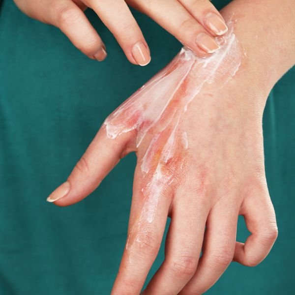 Post Burn Injuries & Contractures