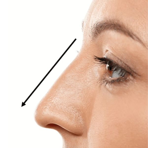 Aesthetic Rhinoplasty (Nose Reshaping)