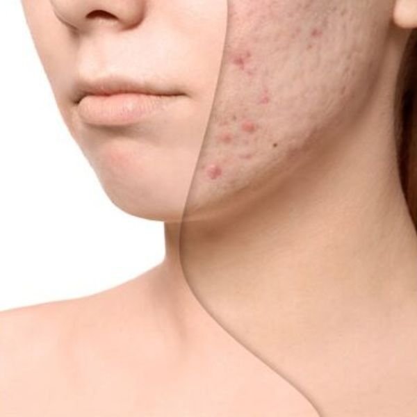 Scar Reduction