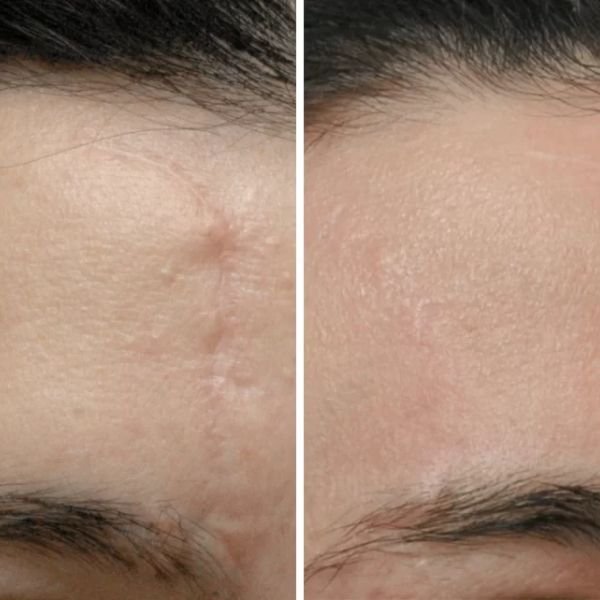 Scar Revision