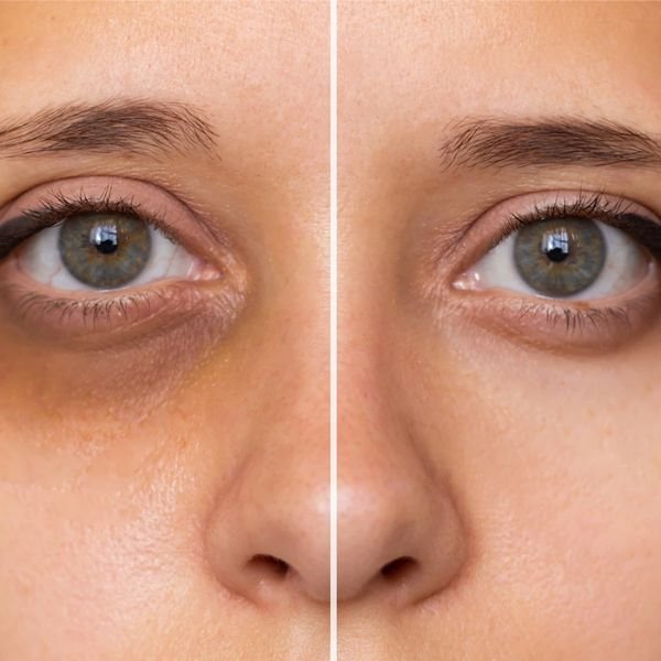 Under Eye Dark Circles Correction