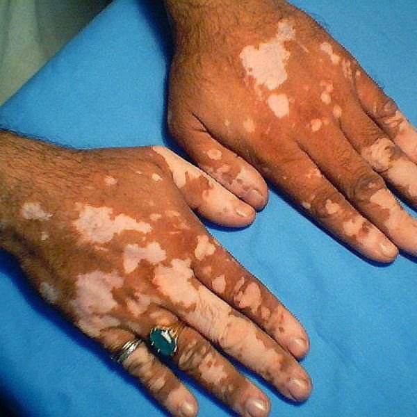 Vitiligo Surgeries