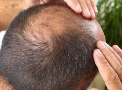 Hair Regrowth Treatments