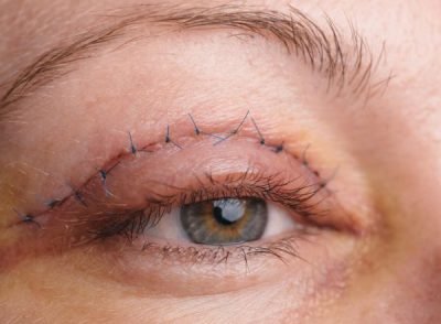 Blepharoplasty (Eyelid Surgery)