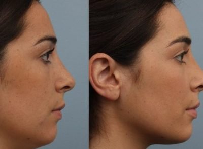 Double Chin Reduction