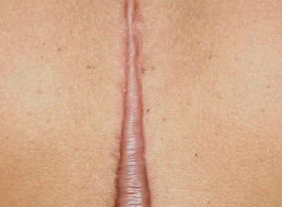 Keloid Treatment