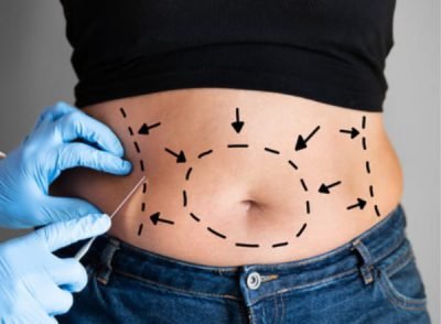 Liposuction