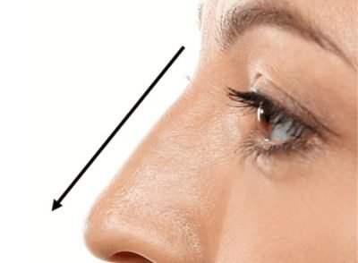 Rhinoplasty (Nose Job)