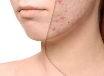 Scar Reduction