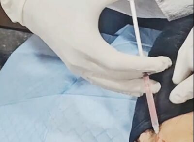 Thread Lift 1