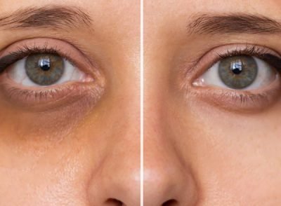 Under Eye Dark Circles Correction