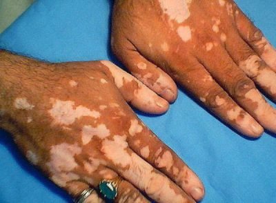 Vitiligo Surgeries
