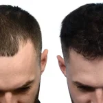 Hair Transplant with Natural Results